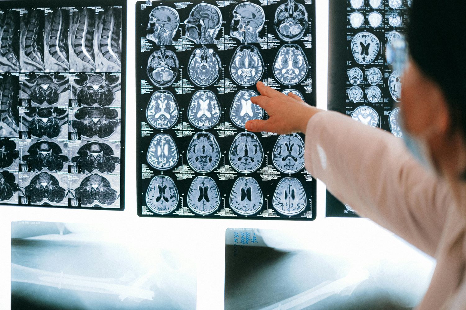 Brain Stroke Patient leg weakness and balance recovered through acupuncture treatment.