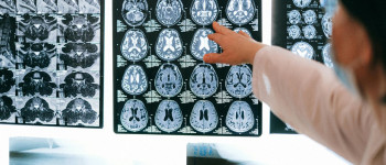 Brain Stroke Patient leg weakness and balance recovered through acupuncture treatment.